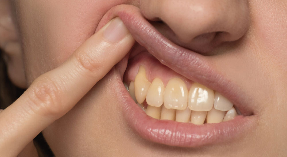 Gum Recession
