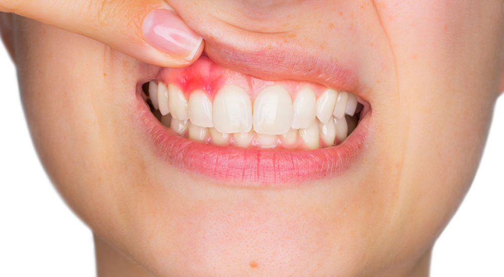 Gum Diseases (Periodontology)