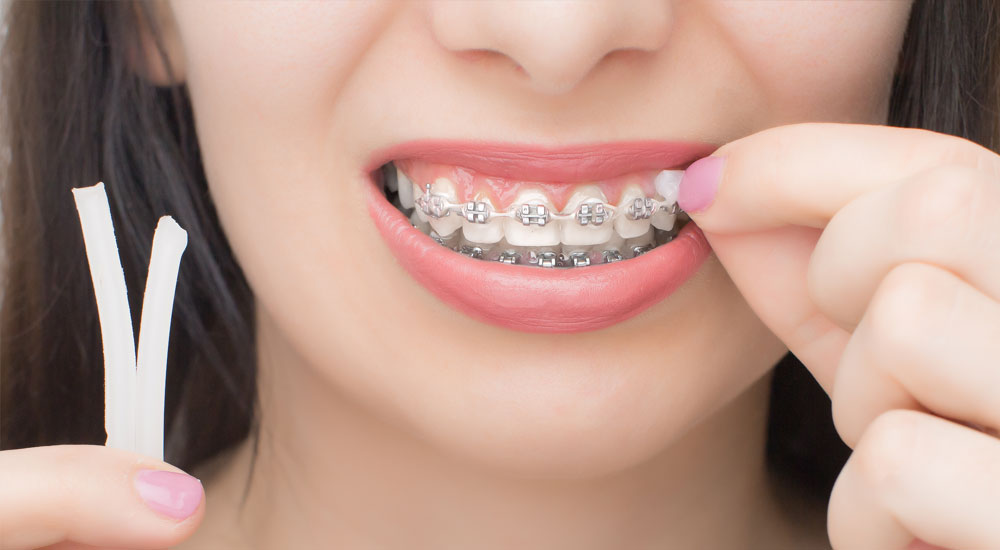 Braces Treatment (Orthodontics)