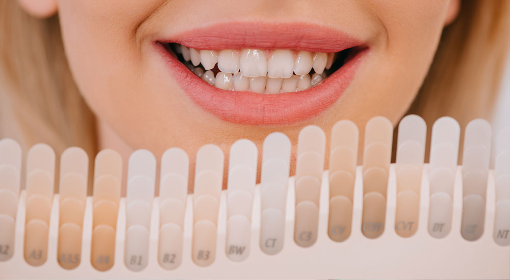 Porcelain Laminated Teeth
